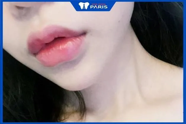 Nếu sưng không giảm: các lựa chọn xử trí y tế là gì và khi nào dùng hyaluronidase?