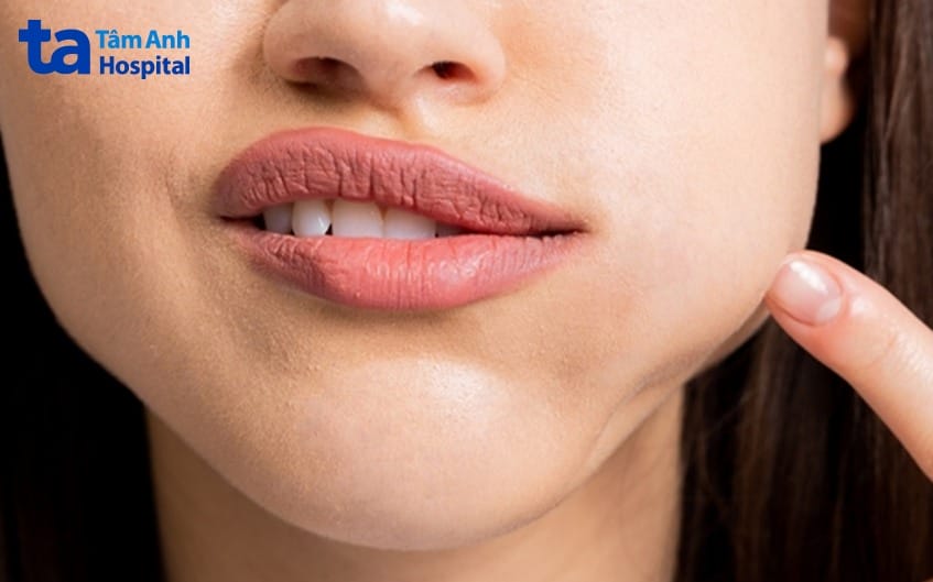 Các loại filler và xu hướng gây sưng — có nên chọn loại filler cụ thể để giảm sưng?