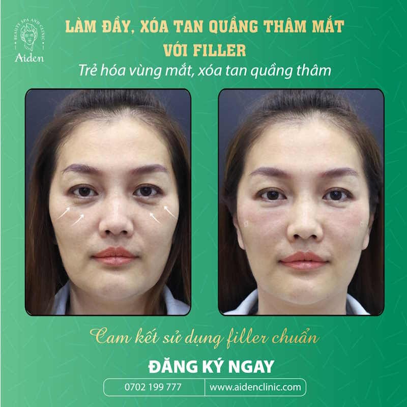 Filler tác động ra sao ở khoé mắt — cơ chế và lựa chọn chất liệu?