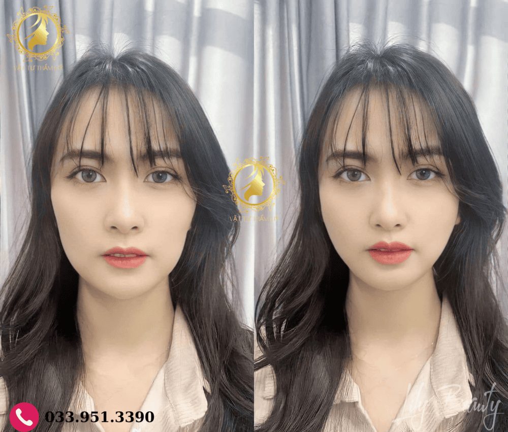 Khi nào không nên tiêm filler cho vùng má — các chống chỉ định phổ biến?