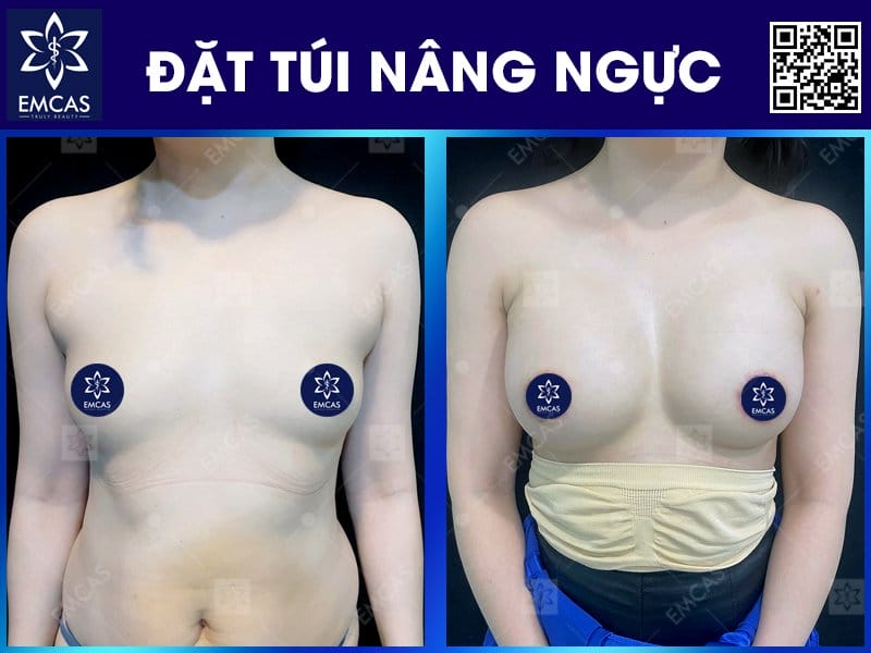 Quy trình tiêm filler ngực an toàn tại clinic