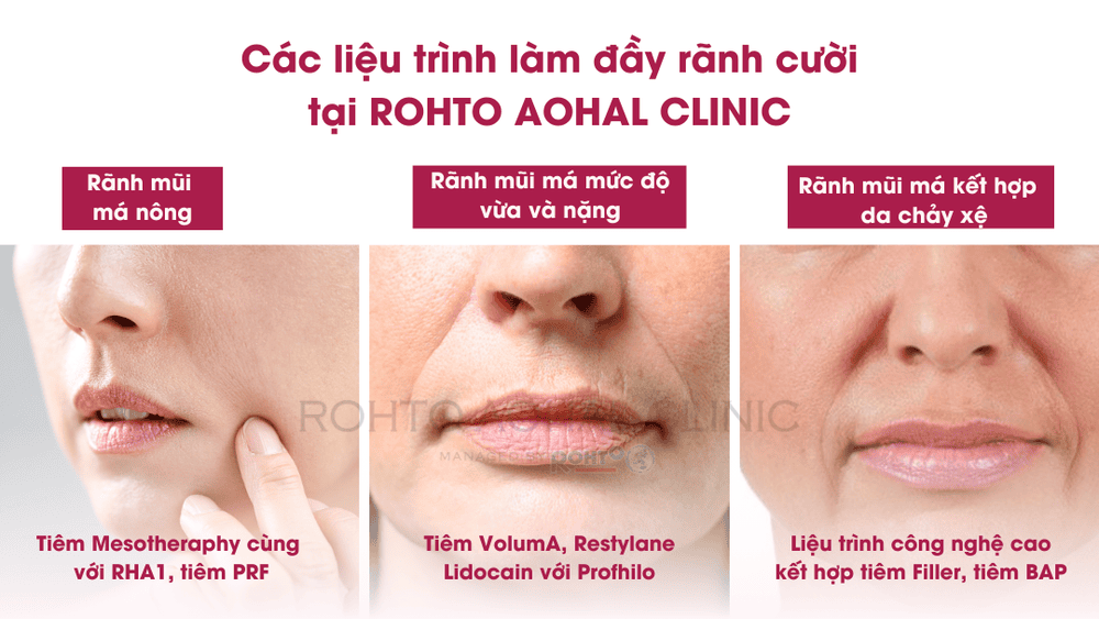 Loại filler nào đang dùng ở Việt Nam và loại nào nên ưu tiên?