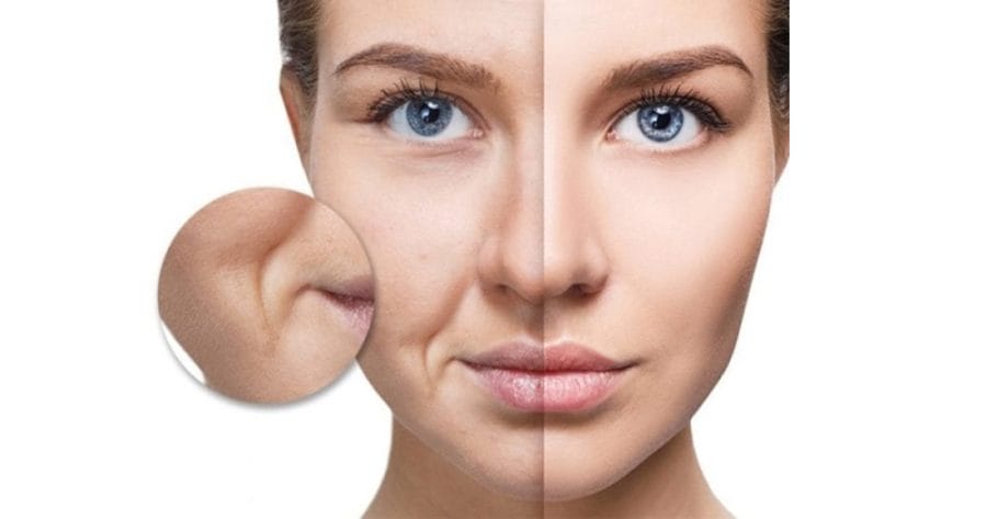 So sánh tiêm filler với các phương pháp khác cho rãnh mũi má — nên chọn phương án nào?