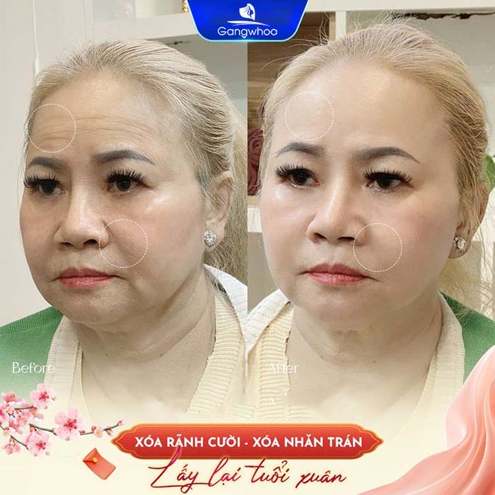 Tiêm ở rãnh mũi má — kỹ thuật an toàn để hạn chế rủi ro tắc mạch khi tiêm filler là gì?