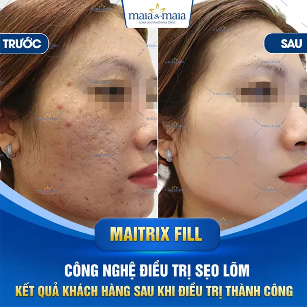 Tiêm filler có thật sự làm đầy sẹo rỗ (sẹo lõm) được không?