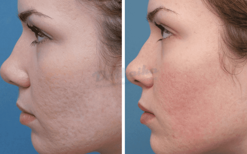 Loại filler nào phù hợp nhất cho từng loại sẹo rỗ?