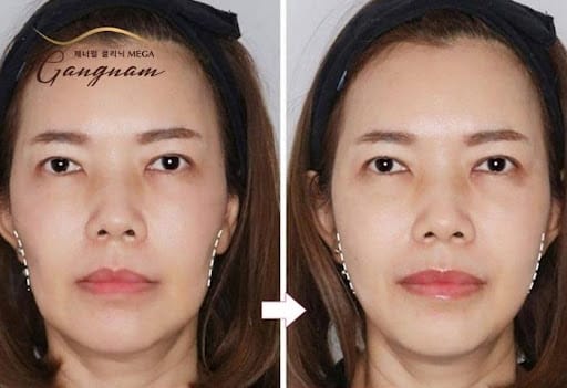 Tiêm filler má baby khác gì so với các phương pháp làm đầy khác — nên chọn phương pháp nào?