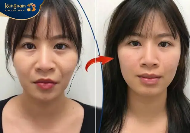 Lời khuyên thực tế để tránh “làm đẹp hối hận” khi muốn má baby