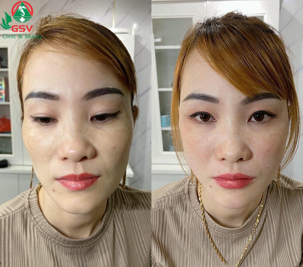 Hyaluronidase hòa tan filler — khi nào nên dùng? Có làm mềm ngay không?