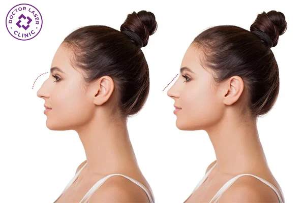 Nếu còn cục sau 2 tuần thì có phải filler bị lỗi?