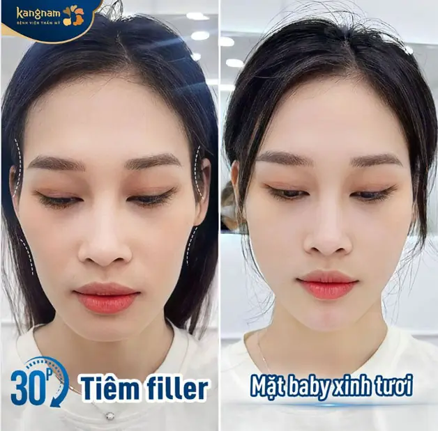 Tại sao tiêm filler vùng má có thể dẫn đến biến chứng tắc mạch — cơ chế tác động là gì?