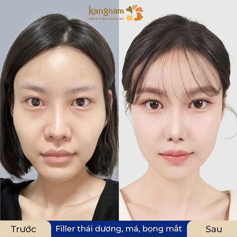 Cách xử trí khi có biến chứng — đặc biệt tắc mạch do HA