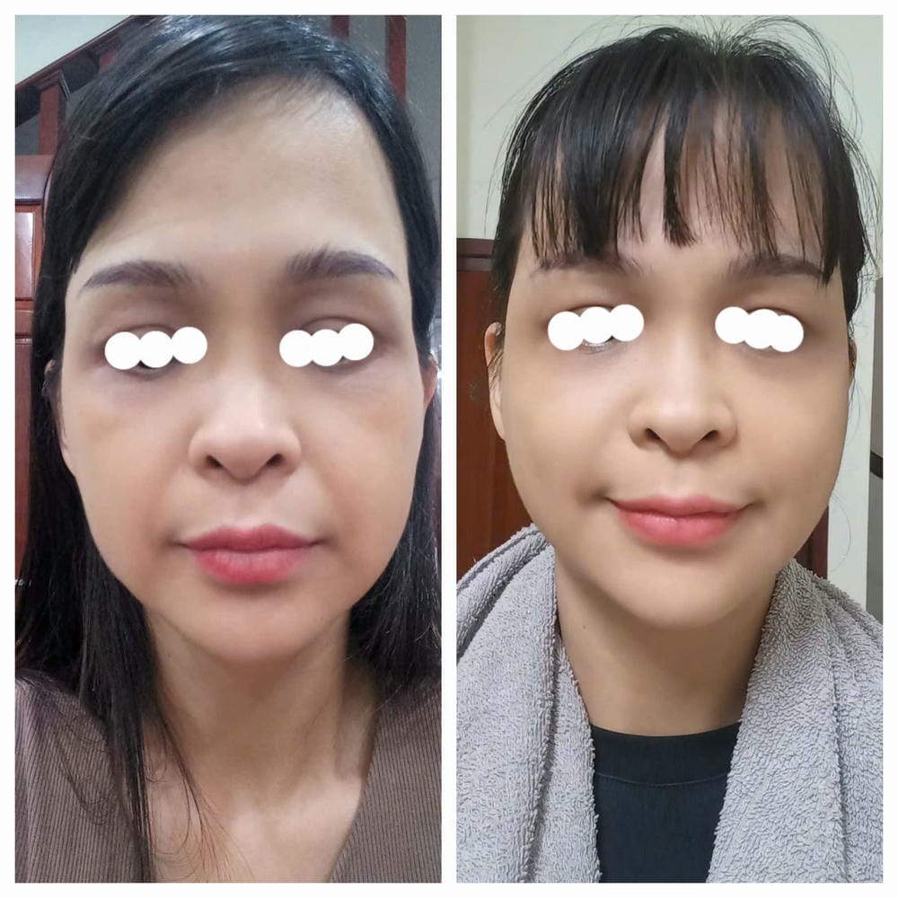 Quy trình tiêm filler má hóp an toàn: từng bước cần biết trước khi quyết định