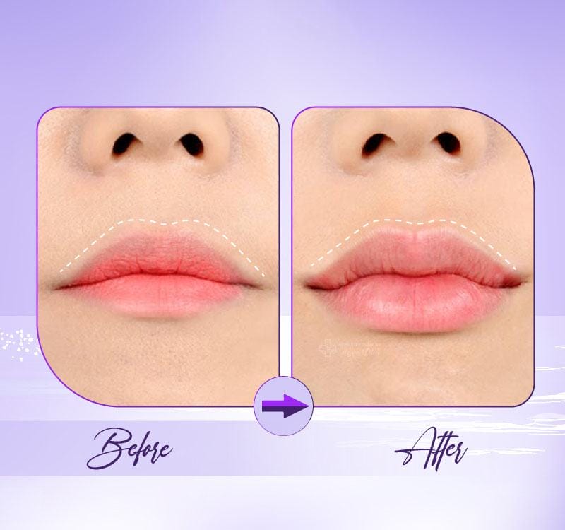 Tại sao giá tiêm filler môi 1cc lại chênh lệch?