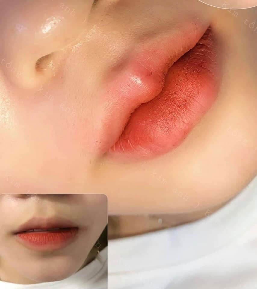 Ai phù hợp tiêm môi baby — và ai nên hoãn hoặc tránh?
