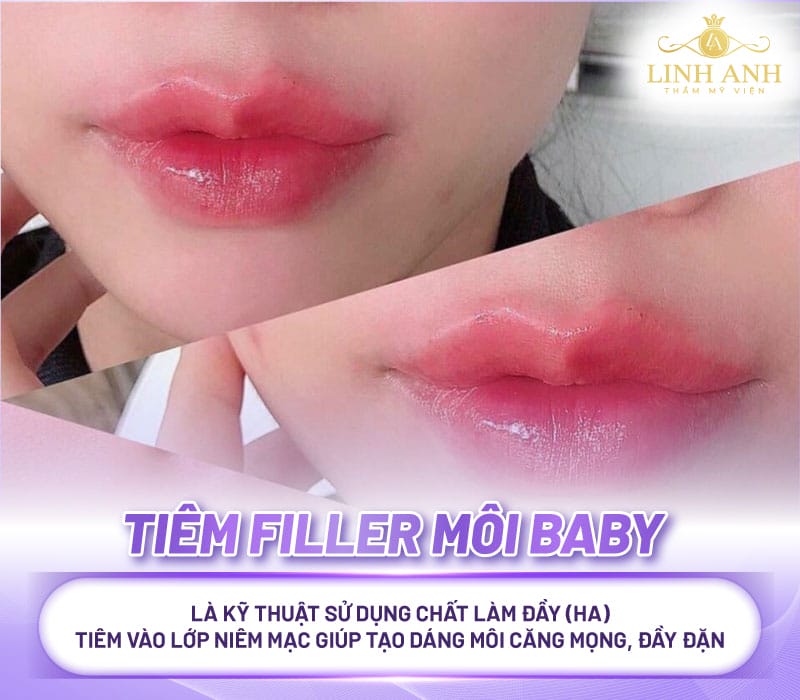 Những loại filler nào thường dùng và nên chọn thương hiệu nào tại Việt Nam?