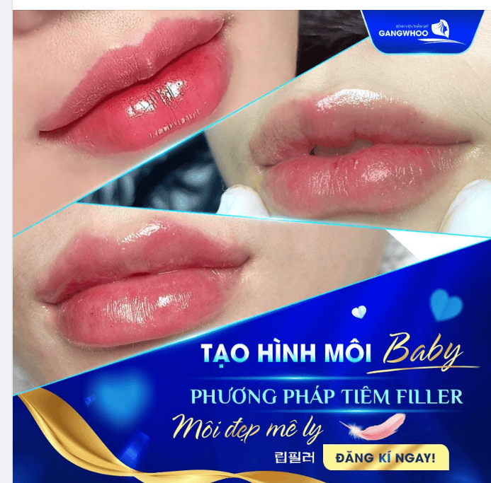Chăm sóc sau tiêm để giữ dáng môi baby đẹp lâu hơn