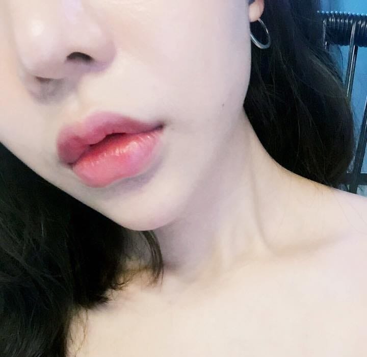 So sánh rủi ro giữa các loại filler và lưu ý về nguồn gốc (ưu tiên filler HA)