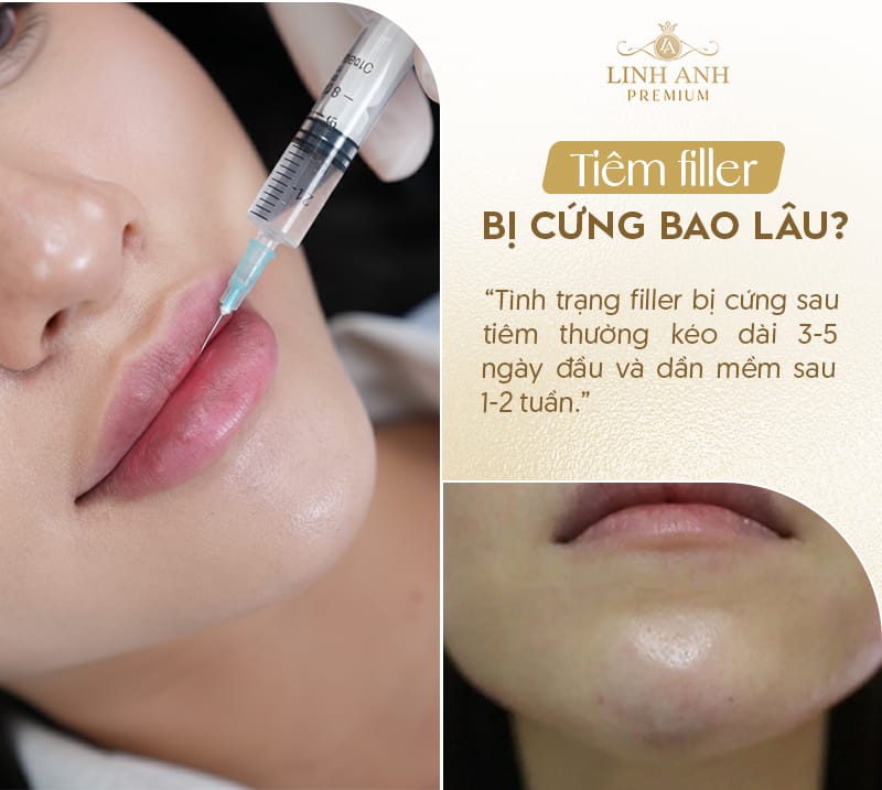 Dấu hiệu biến chứng tiêm filler môi cần lưu ý