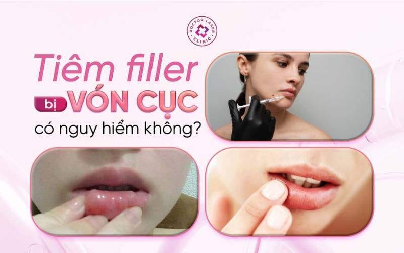 Lựa chọn phương pháp: massage, tan filler, kháng sinh, hay phẫu thuật — so sánh ưu nhược điểm?