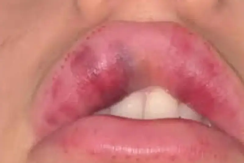 Tiêm filler môi có hại không — khi nào cần lo và khi nào có thể yên tâm?