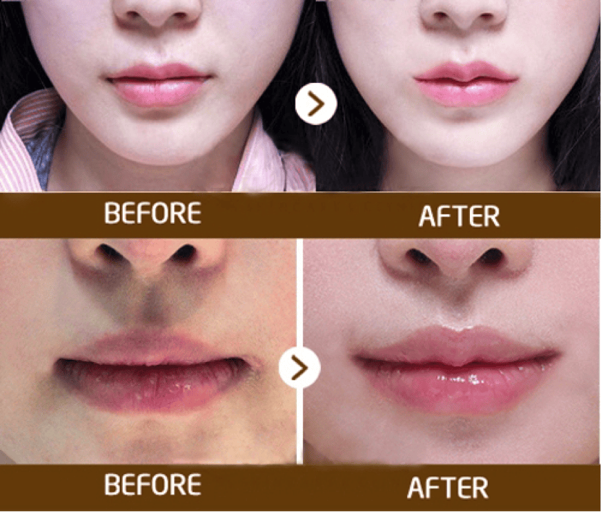 Làm sao để chọn nơi an toàn khi lo lắng “tiêm filler môi có hại không”?
