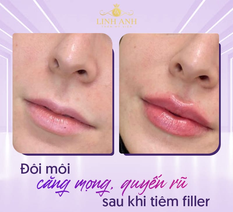Tiêm filler môi có kiêng gì không — ai không nên tiêm hoặc cần thận trọng đặc biệt?