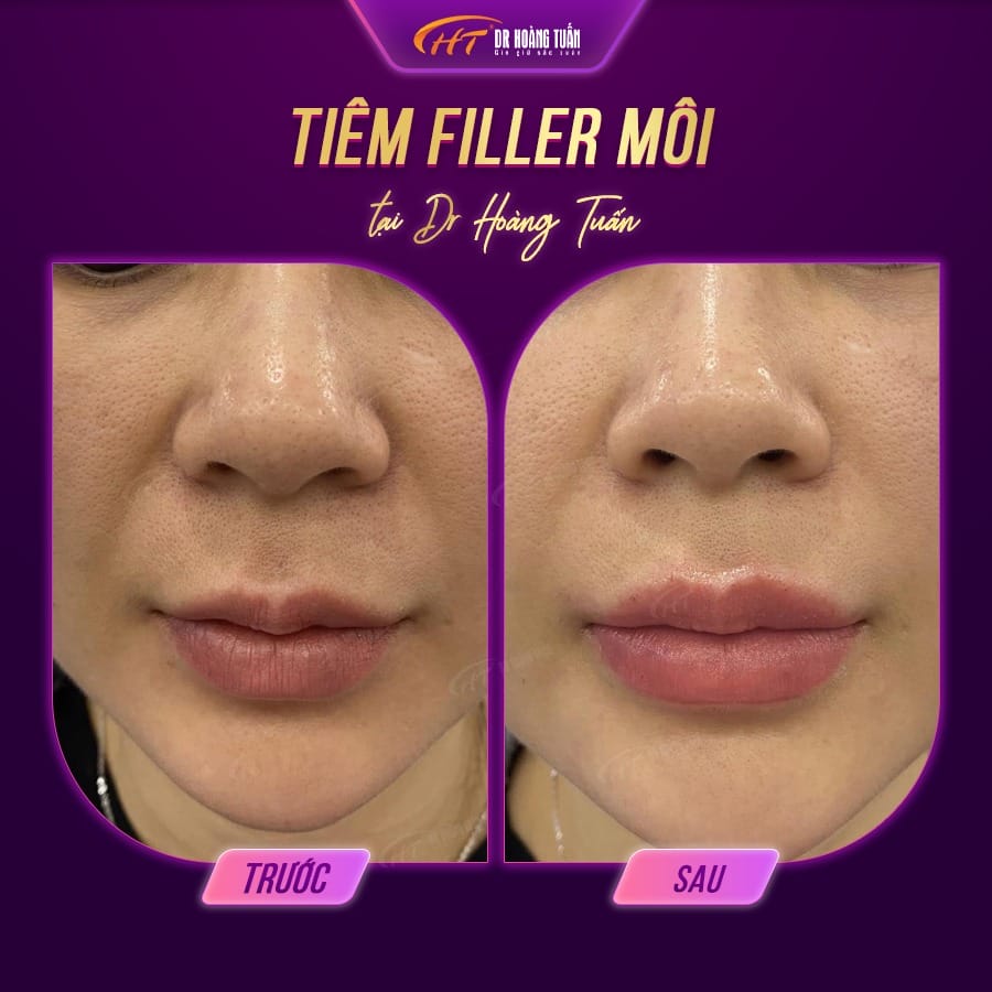 Các yếu tố ảnh hưởng khiến filler tan nhanh hay lâu?