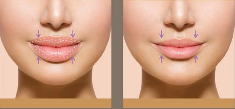 Có thể biến môi đã tiêm filler dày thành mỏng được không — và bằng cách nào?