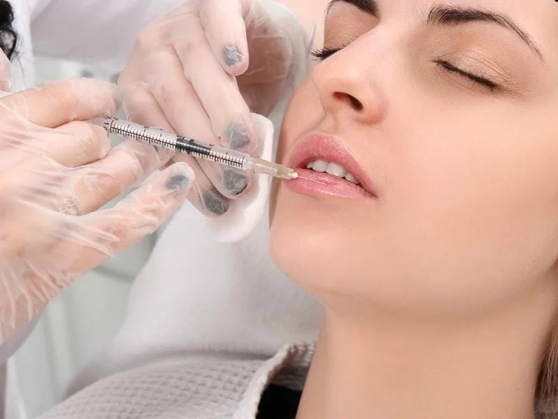 Quy trình điển hình khi muốn làm mỏng môi đã tiêm filler là gì?