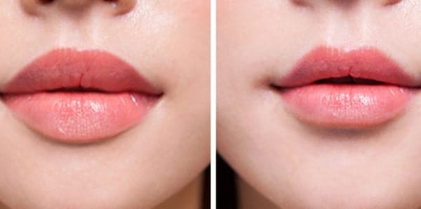 Rủi ro, tác dụng phụ và khi nào không nên tiêm tan ngay?