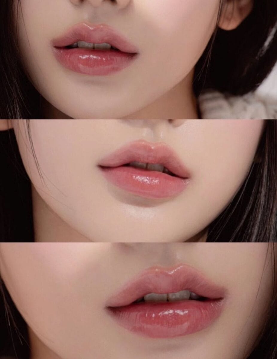 Muốn tiêm lại sau khi đã làm mỏng hoặc lần đầu tiêm — nên chọn filler nào để dễ chỉnh sửa?