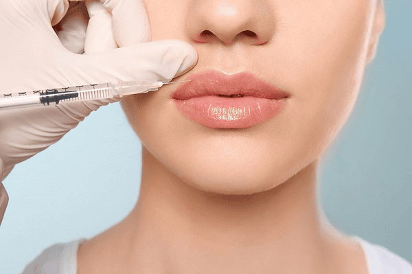 Có những loại filler môi nào — nên chọn HA hay filler “không tan”?
