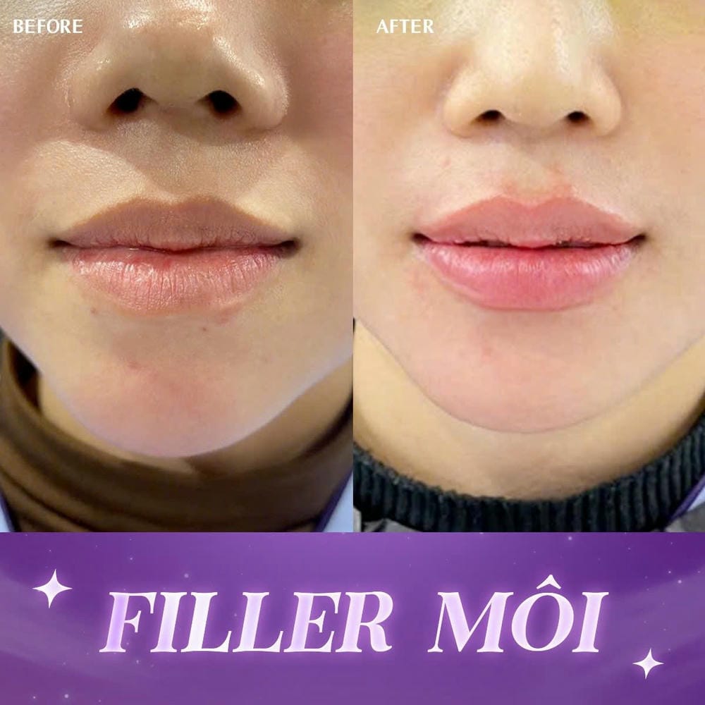 Ai phù hợp và ai nên tránh tiêm filler môi?