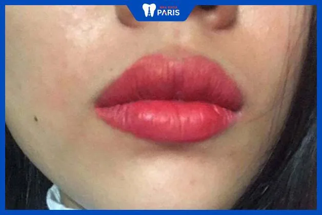 Filler loại nào phù hợp cho môi và kỹ thuật ảnh hưởng ra sao?