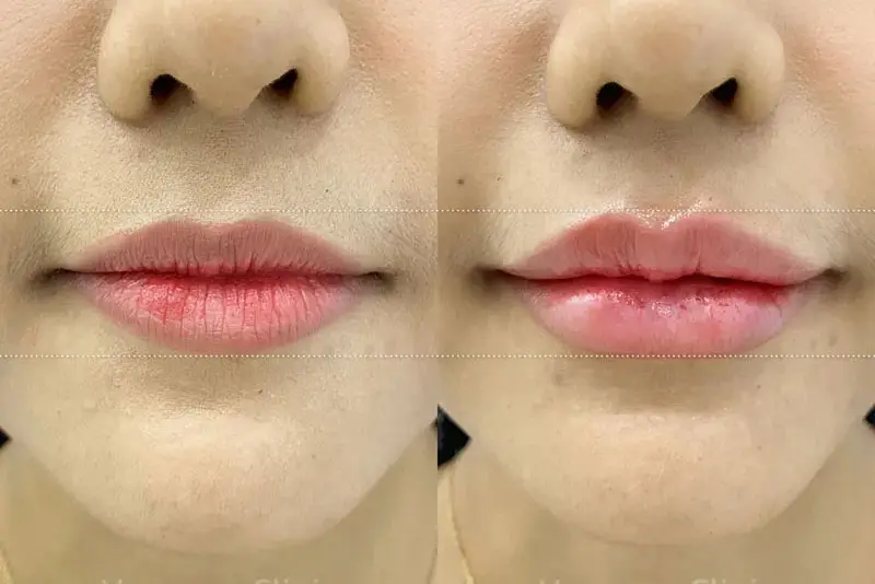 Những dấu hiệu cấp cứu sau tiêm filler môi cần nhận biết ngay (tắc mạch khi tiêm filler)
