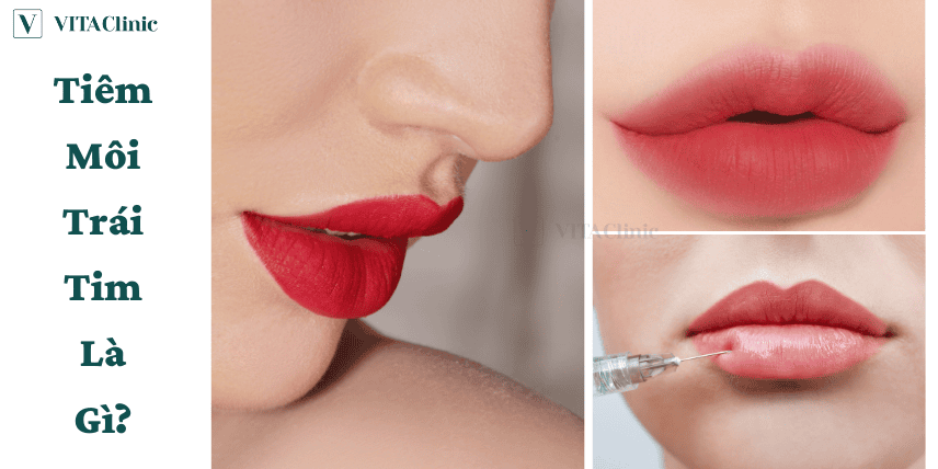 Kỹ thuật nào an toàn hơn cho môi: kim hay cannula? Và có nên dùng siêu âm hướng dẫn?