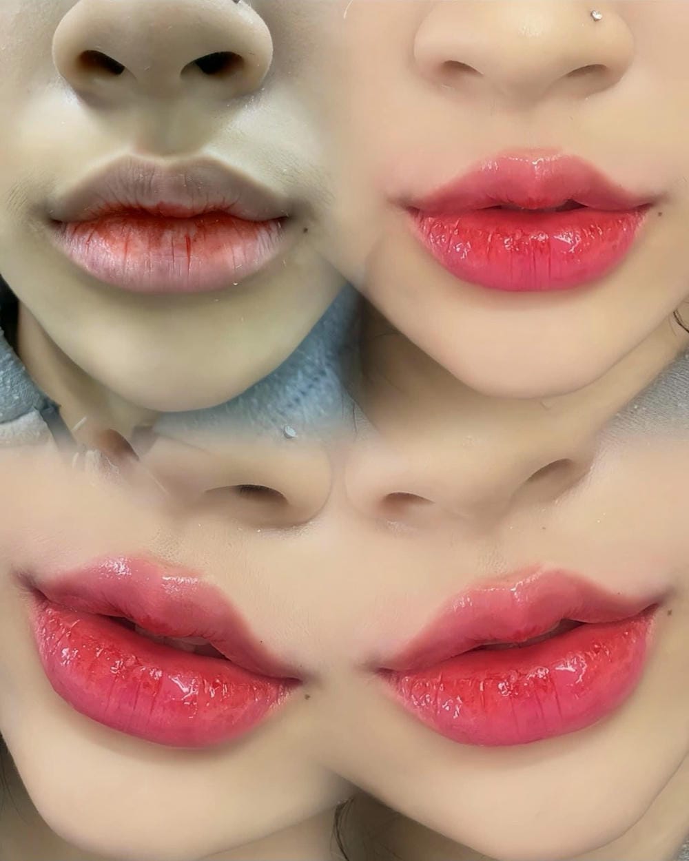 Lona Skin Lab có thể giúp thế nào nếu quyết định làm môi trên?