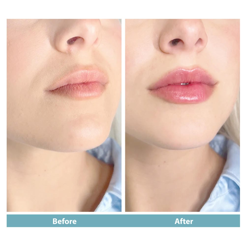 Giá tiêm filler môi ở TP HCM, Hà Nội và Cần Thơ — tiêu chí chọn nơi tốt?