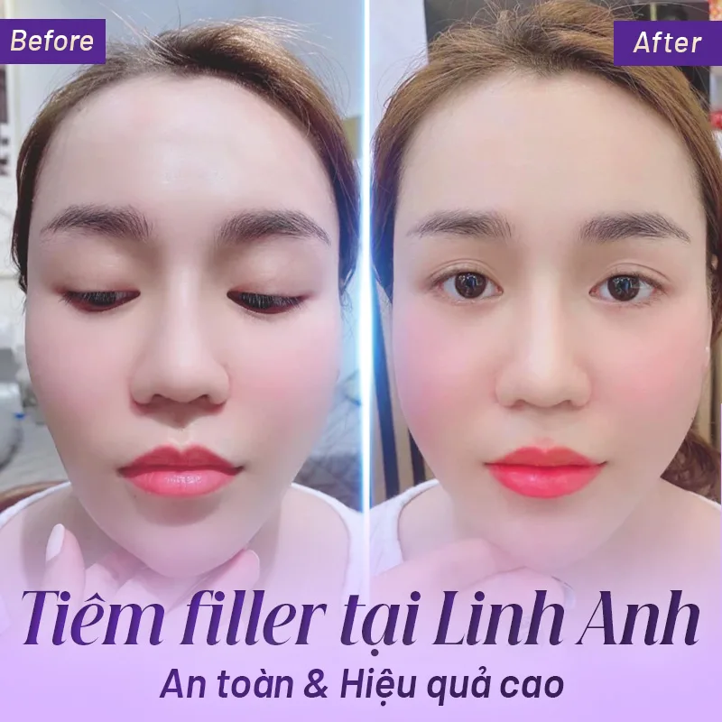 Làm sao biết một nơi tiêm filler môi là an toàn?