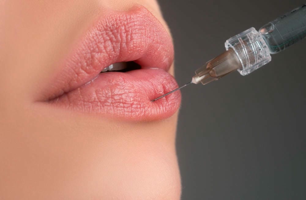 Hyaluronidase là gì và vai trò khi tiêm filler môi?