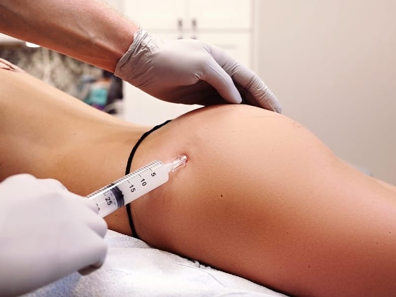 So sánh: tiêm filler mông, cấy mỡ tự thân BBL và đặt implant mông — phương án nào an toàn hơn?