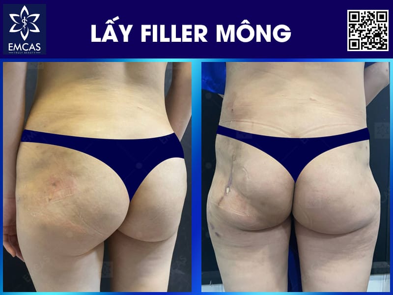 Tiêm filler mông có tốt không — nó hoạt động thế nào và dành cho ai?