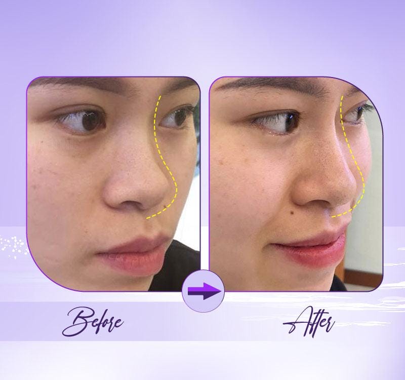 Filler hãng nào phù hợp cho mũi — Vivacy, Opera, Aileene có khác nhau thế nào?