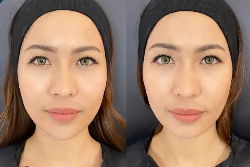 Làm thế nào nếu muốn filler mũi tan nhanh hoặc cần tháo ngay lập tức?