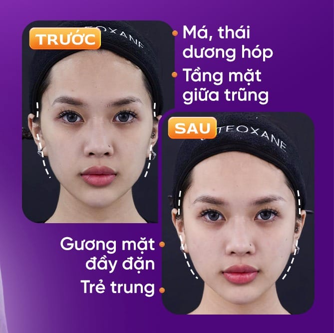 Nên chọn loại filler hãng nào và tiêu chí chọn cơ sở thực hiện như thế nào?