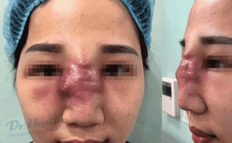 Khi nào sưng là dấu hiệu của biến chứng filler mũi cần tới bác sĩ ngay?