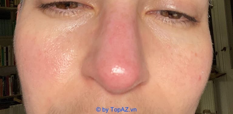 Làm sao phân biệt sưng do phản ứng bình thường, dị ứng, nhiễm trùng hay granuloma?