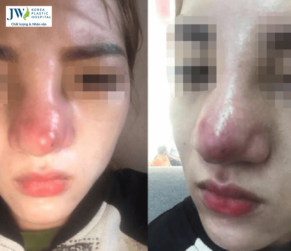 Lưu ý chăm sóc tại nhà và những điều nên tránh để giúp giảm sưng nhanh hơn