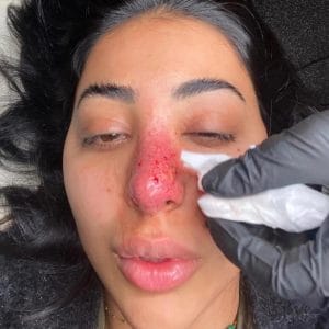 Hyaluronidase có tác dụng gì — tan được tất cả filler không?